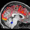 How Deep Sleep May Help The Brain Clear Alzheimer's Toxins
